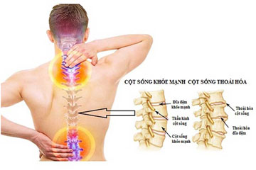 Hướng dẫn cách giảm đau dây thần kinh liên sườn