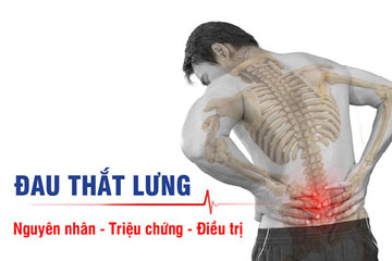 Tự nhiên bị đau lưng không cúi được nên làm gì?